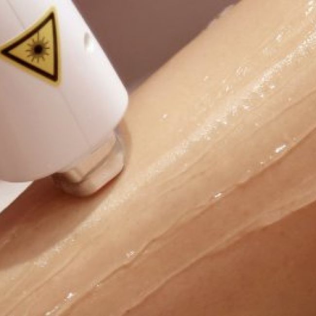 Depilación laser en Castellón